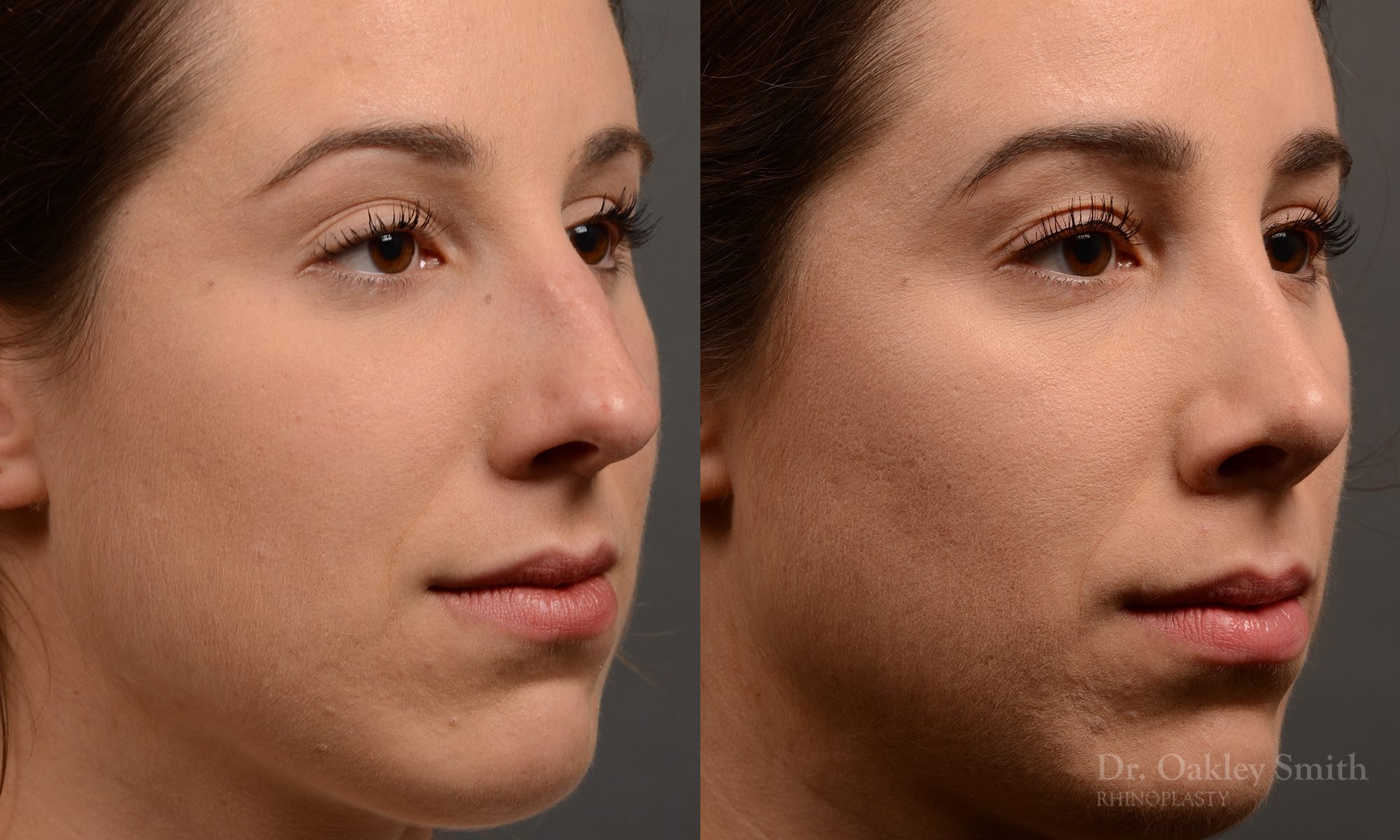 rhinoplasty Nothing demonstrates the skillful craftsmanship that Dr. Oakley Smith accomplishes during his surgeries than a collection of before and after case studies. As one of a hand full of surgeons in North America who limits his practice to only Rhinoplasty surgery, it is obvious that he has mastered his art. There is no question why he is one of the busiest cosmetic nose job surgeons in the country.