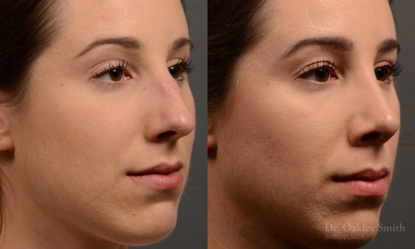 rhinoplasty Nothing demonstrates the skillful craftsmanship that Dr. Oakley Smith accomplishes during his surgeries than a collection of before and after case studies. As one of a hand full of surgeons in North America who limits his practice to only Rhinoplasty surgery, it is obvious that he has mastered his art. There is no question why he is one of the busiest cosmetic nose job surgeons in the country.