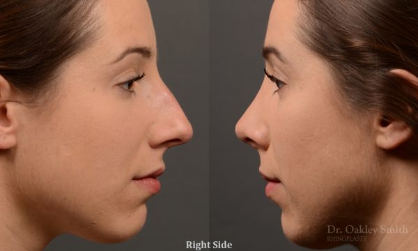 rhinoplasty Nothing demonstrates the skillful craftsmanship that Dr. Oakley Smith accomplishes during his surgeries than a collection of before and after case studies. As one of a hand full of surgeons in North America who limits his practice to only Rhinoplasty surgery, it is obvious that he has mastered his art. There is no question why he is one of the busiest cosmetic nose job surgeons in the country.