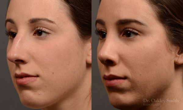 rhinoplasty Nothing demonstrates the skillful craftsmanship that Dr. Oakley Smith accomplishes during his surgeries than a collection of before and after case studies. As one of a hand full of surgeons in North America who limits his practice to only Rhinoplasty surgery, it is obvious that he has mastered his art. There is no question why he is one of the busiest cosmetic nose job surgeons in the country.