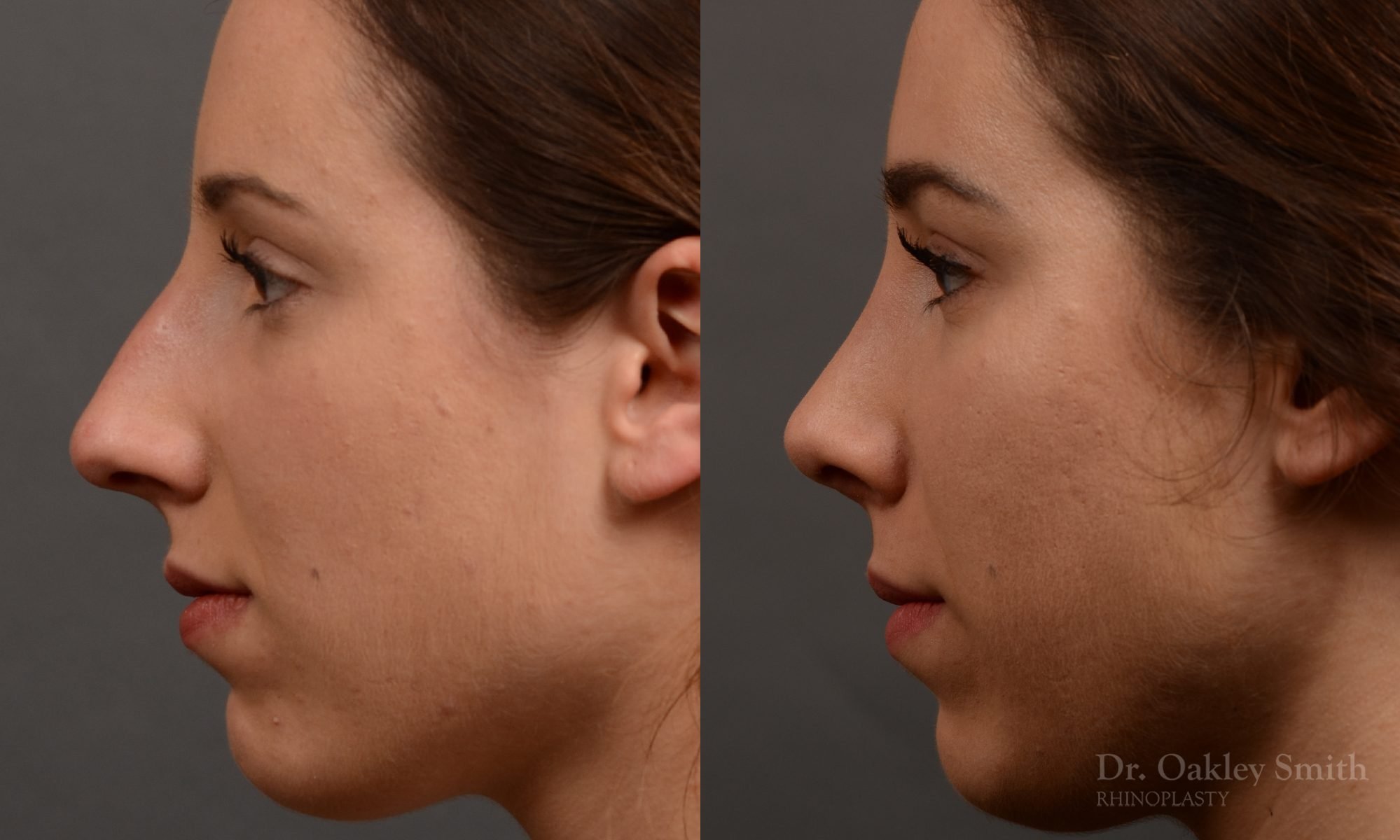 rhinoplasty Nothing demonstrates the skillful craftsmanship that Dr. Oakley Smith accomplishes during his surgeries than a collection of before and after case studies. As one of a hand full of surgeons in North America who limits his practice to only Rhinoplasty surgery, it is obvious that he has mastered his art. There is no question why he is one of the busiest cosmetic nose job surgeons in the country.