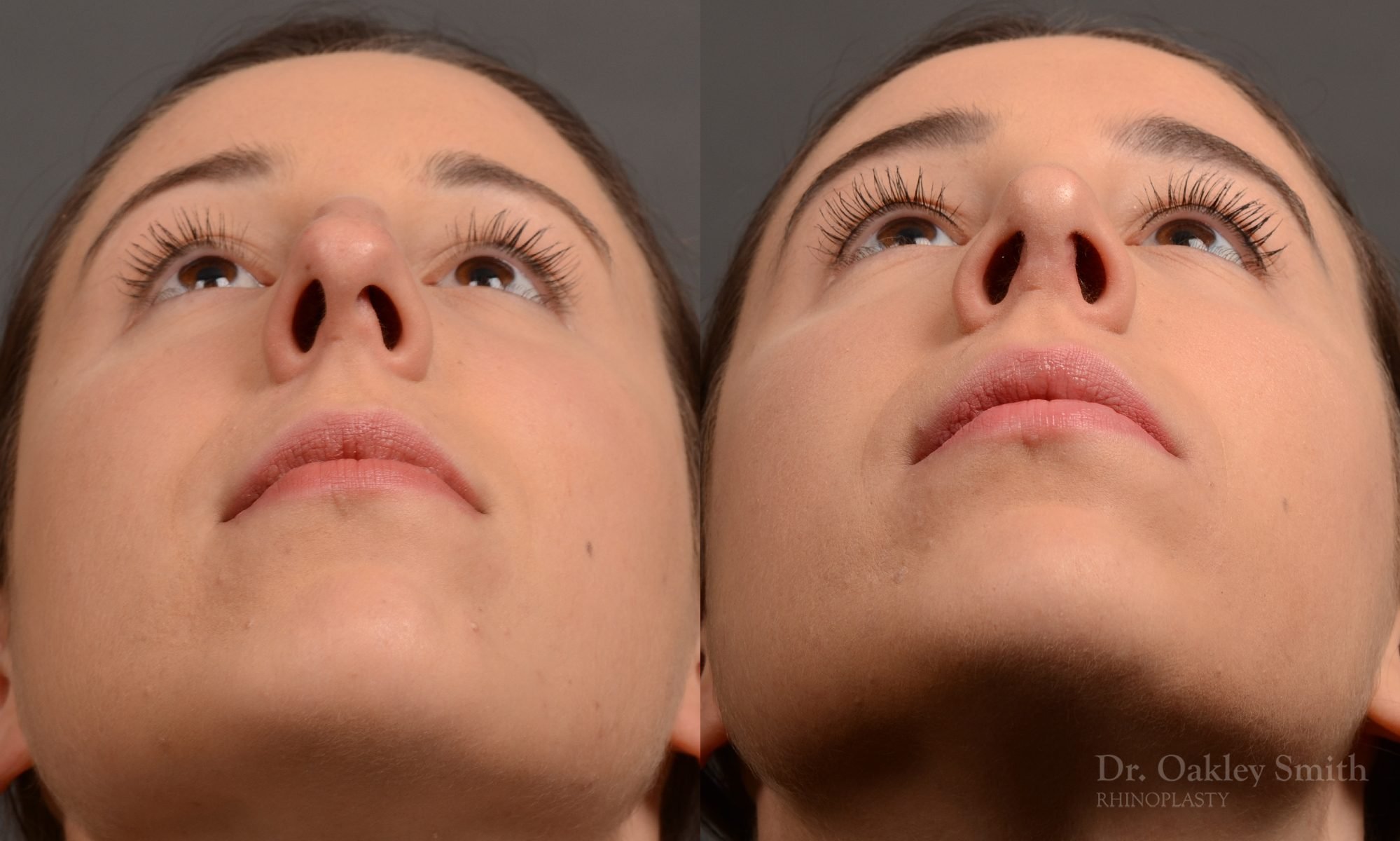 rhinoplasty Nothing demonstrates the skillful craftsmanship that Dr. Oakley Smith accomplishes during his surgeries than a collection of before and after case studies. As one of a hand full of surgeons in North America who limits his practice to only Rhinoplasty surgery, it is obvious that he has mastered his art. There is no question why he is one of the busiest cosmetic nose job surgeons in the country.