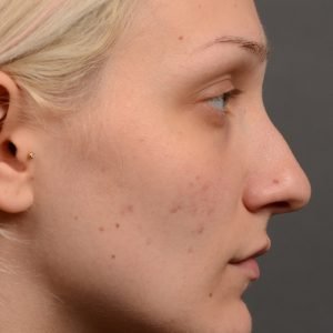 rhinoplasty Nothing demonstrates the skillful craftsmanship that Dr. Oakley Smith accomplishes during his surgeries than a collection of before and after case studies. As one of a hand full of surgeons in North America who limits his practice to only Rhinoplasty surgery, it is obvious that he has mastered his art. There is no question why he is one of the busiest cosmetic nose job surgeons in the country.