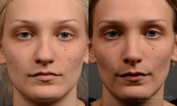 rhinoplasty Nothing demonstrates the skillful craftsmanship that Dr. Oakley Smith accomplishes during his surgeries than a collection of before and after case studies. As one of a hand full of surgeons in North America who limits his practice to only Rhinoplasty surgery, it is obvious that he has mastered his art. There is no question why he is one of the busiest cosmetic nose job surgeons in the country.