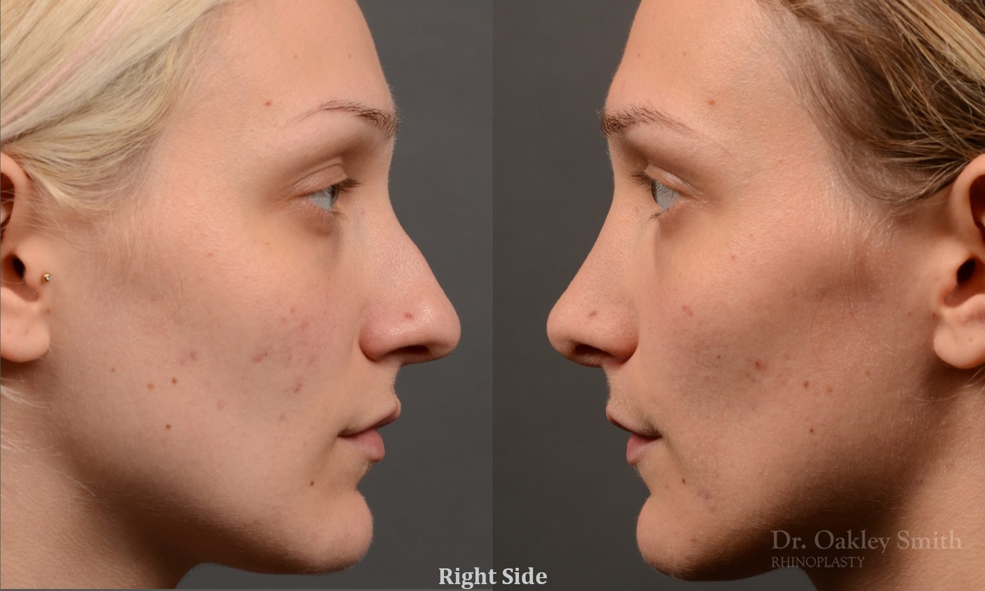 rhinoplasty Nothing demonstrates the skillful craftsmanship that Dr. Oakley Smith accomplishes during his surgeries than a collection of before and after case studies. As one of a hand full of surgeons in North America who limits his practice to only Rhinoplasty surgery, it is obvious that he has mastered his art. There is no question why he is one of the busiest cosmetic nose job surgeons in the country.