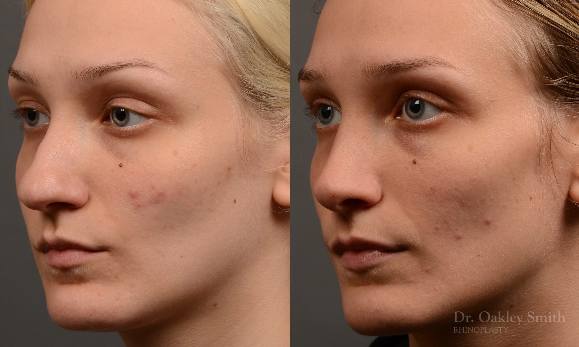 rhinoplasty Nothing demonstrates the skillful craftsmanship that Dr. Oakley Smith accomplishes during his surgeries than a collection of before and after case studies. As one of a hand full of surgeons in North America who limits his practice to only Rhinoplasty surgery, it is obvious that he has mastered his art. There is no question why he is one of the busiest cosmetic nose job surgeons in the country.