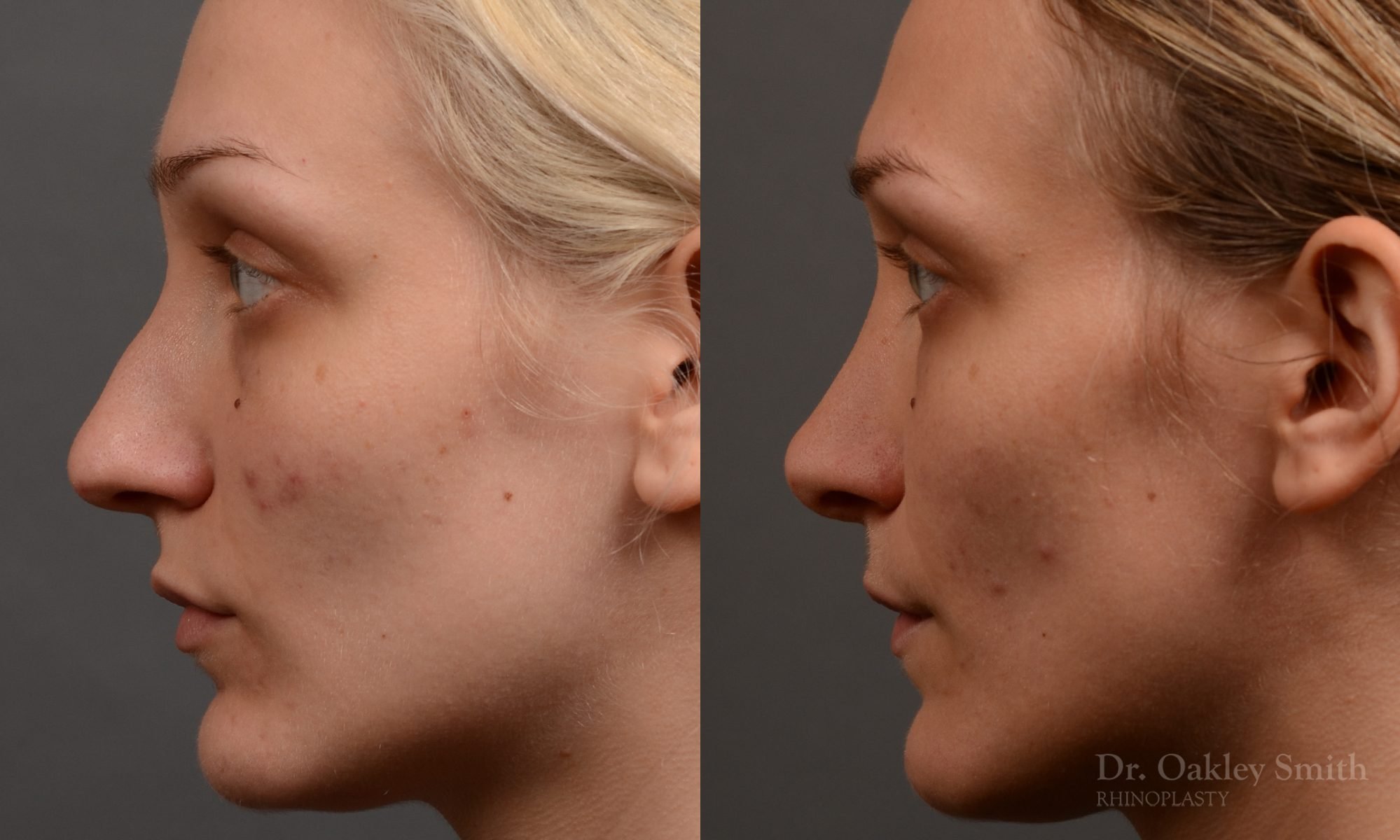 rhinoplasty Nothing demonstrates the skillful craftsmanship that Dr. Oakley Smith accomplishes during his surgeries than a collection of before and after case studies. As one of a hand full of surgeons in North America who limits his practice to only Rhinoplasty surgery, it is obvious that he has mastered his art. There is no question why he is one of the busiest cosmetic nose job surgeons in the country.