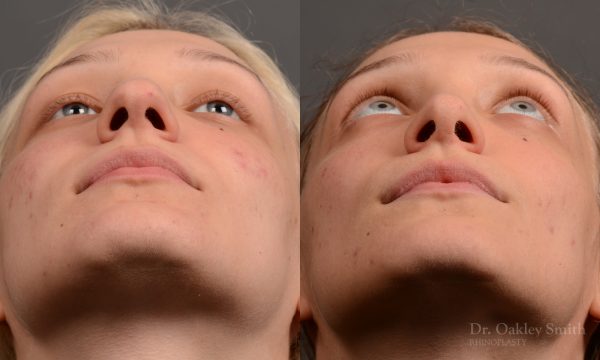 rhinoplasty Nothing demonstrates the skillful craftsmanship that Dr. Oakley Smith accomplishes during his surgeries than a collection of before and after case studies. As one of a hand full of surgeons in North America who limits his practice to only Rhinoplasty surgery, it is obvious that he has mastered his art. There is no question why he is one of the busiest cosmetic nose job surgeons in the country.