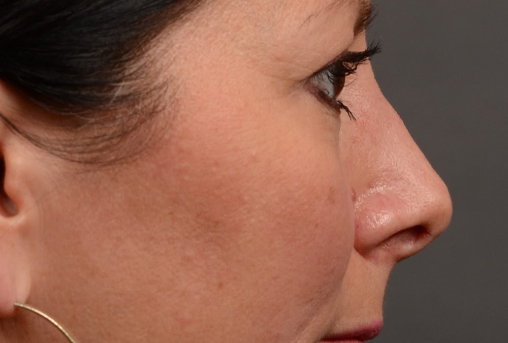 Rhinoplasty Before and After Case 381