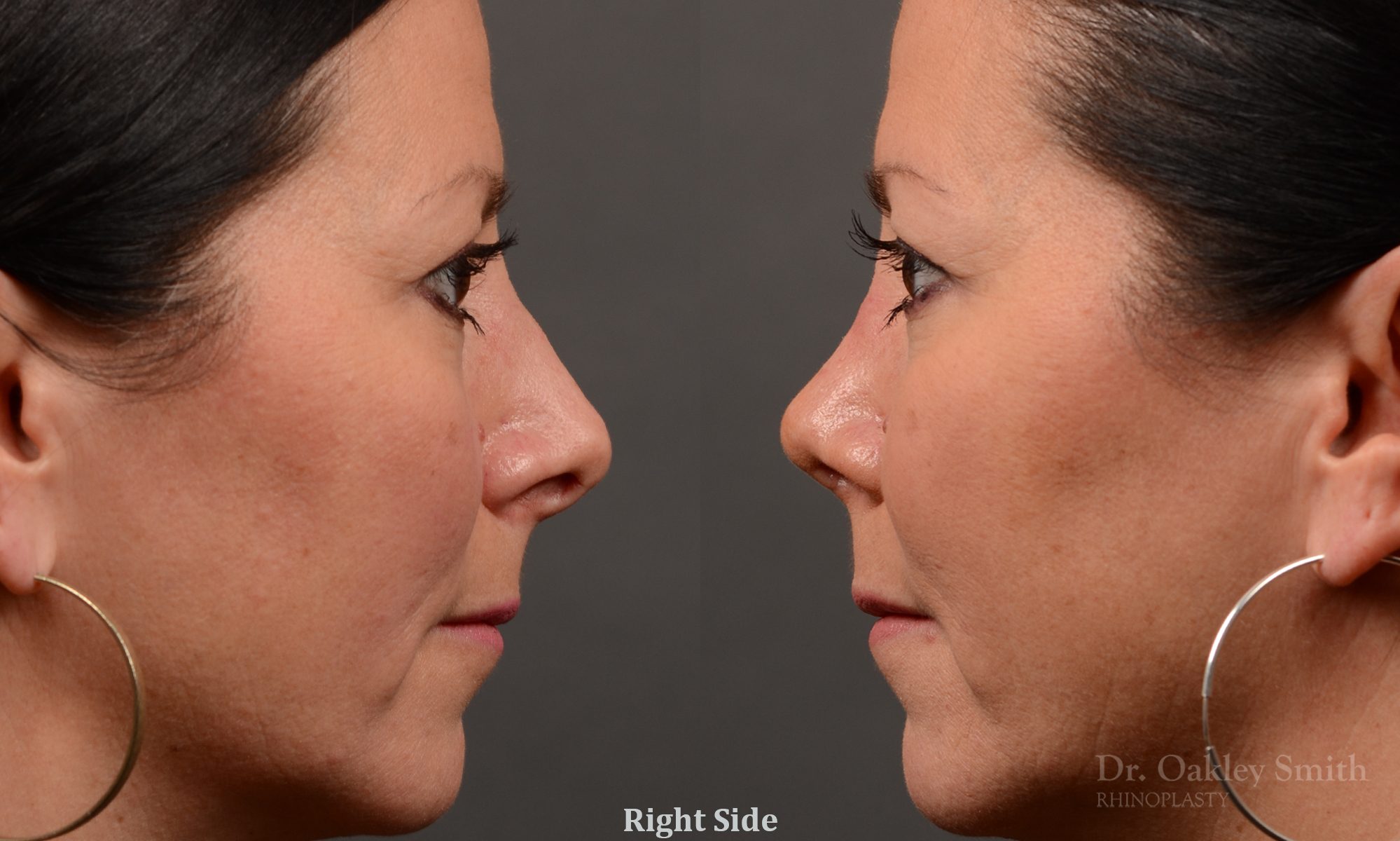 rhinoplasty Nothing demonstrates the skillful craftsmanship that Dr. Oakley Smith accomplishes during his surgeries than a collection of before and after case studies. As one of a hand full of surgeons in North America who limits his practice to only Rhinoplasty surgery, it is obvious that he has mastered his art. There is no question why he is one of the busiest cosmetic nose job surgeons in the country.
