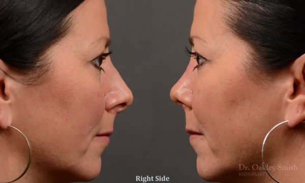 rhinoplasty Nothing demonstrates the skillful craftsmanship that Dr. Oakley Smith accomplishes during his surgeries than a collection of before and after case studies. As one of a hand full of surgeons in North America who limits his practice to only Rhinoplasty surgery, it is obvious that he has mastered his art. There is no question why he is one of the busiest cosmetic nose job surgeons in the country.