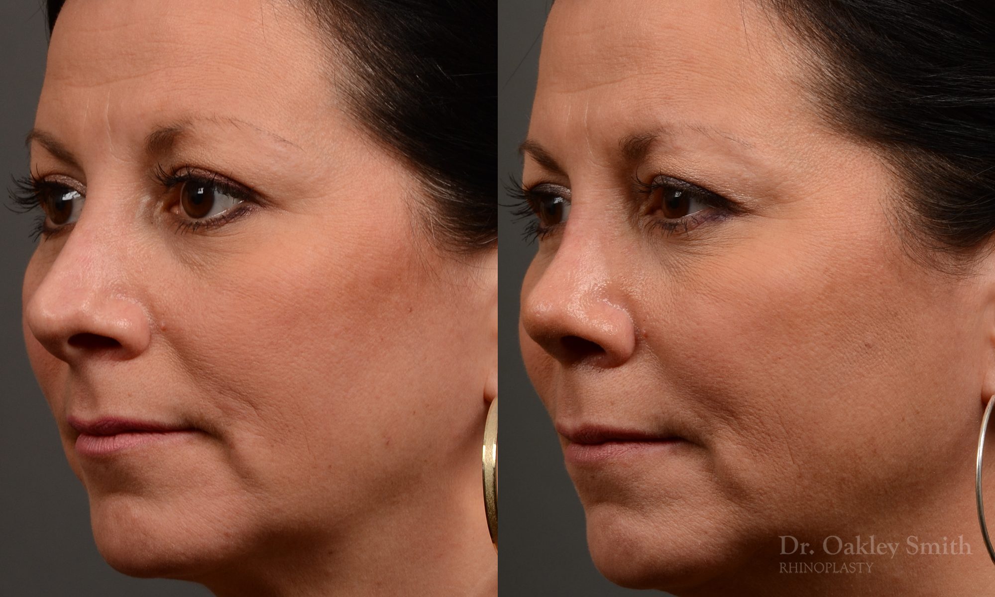 rhinoplasty Nothing demonstrates the skillful craftsmanship that Dr. Oakley Smith accomplishes during his surgeries than a collection of before and after case studies. As one of a hand full of surgeons in North America who limits his practice to only Rhinoplasty surgery, it is obvious that he has mastered his art. There is no question why he is one of the busiest cosmetic nose job surgeons in the country.
