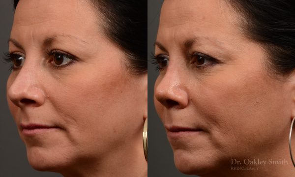 rhinoplasty Nothing demonstrates the skillful craftsmanship that Dr. Oakley Smith accomplishes during his surgeries than a collection of before and after case studies. As one of a hand full of surgeons in North America who limits his practice to only Rhinoplasty surgery, it is obvious that he has mastered his art. There is no question why he is one of the busiest cosmetic nose job surgeons in the country.