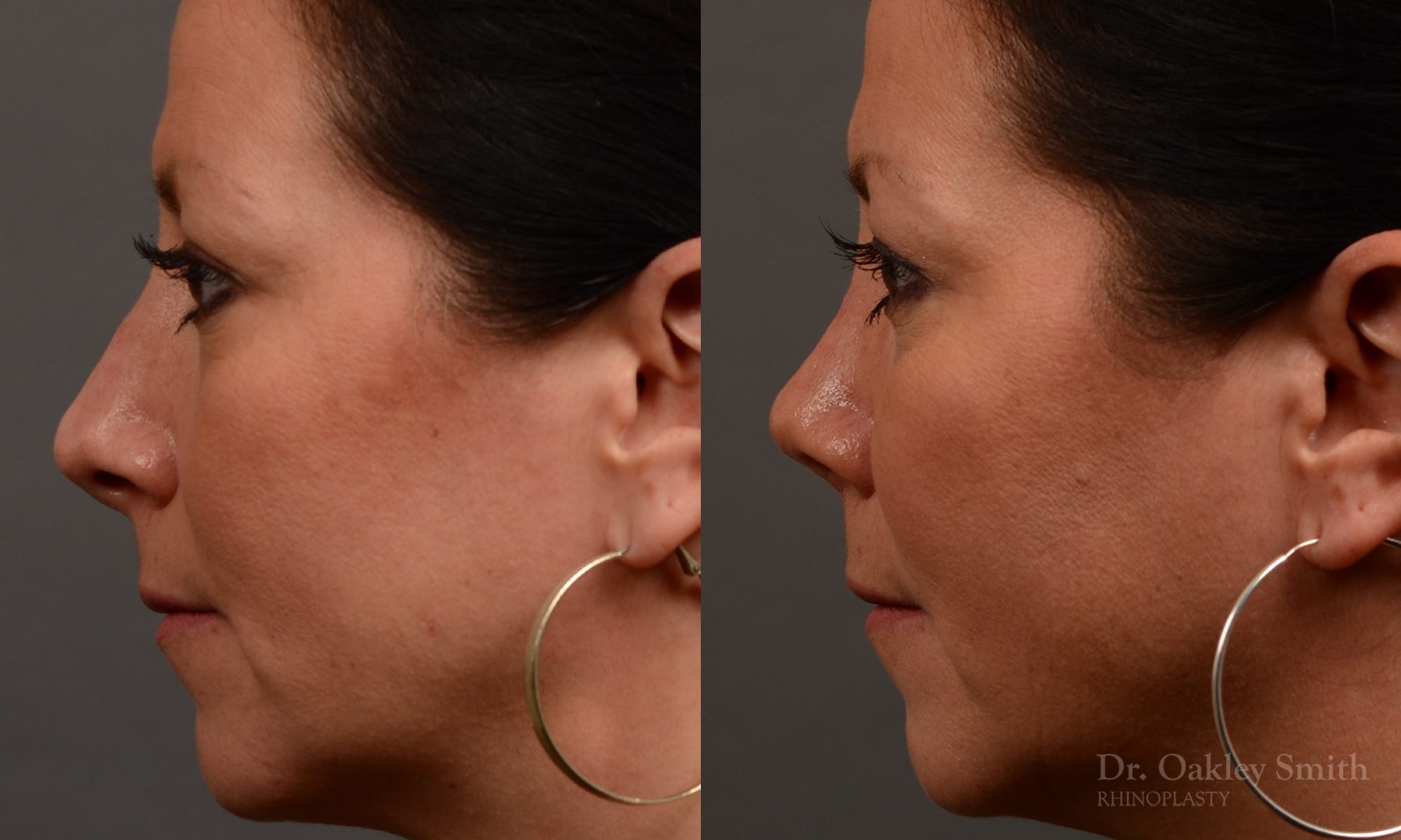 rhinoplasty Nothing demonstrates the skillful craftsmanship that Dr. Oakley Smith accomplishes during his surgeries than a collection of before and after case studies. As one of a hand full of surgeons in North America who limits his practice to only Rhinoplasty surgery, it is obvious that he has mastered his art. There is no question why he is one of the busiest cosmetic nose job surgeons in the country.