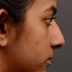 Rhinoplasty - Rhinoplasty Before and After Case 383