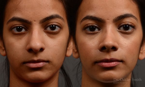 rhinoplasty Nothing demonstrates the skillful craftsmanship that Dr. Oakley Smith accomplishes during his surgeries than a collection of before and after case studies. As one of a hand full of surgeons in North America who limits his practice to only Rhinoplasty surgery, it is obvious that he has mastered his art. There is no question why he is one of the busiest cosmetic nose job surgeons in the country.