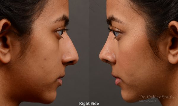 rhinoplasty Nothing demonstrates the skillful craftsmanship that Dr. Oakley Smith accomplishes during his surgeries than a collection of before and after case studies. As one of a hand full of surgeons in North America who limits his practice to only Rhinoplasty surgery, it is obvious that he has mastered his art. There is no question why he is one of the busiest cosmetic nose job surgeons in the country.