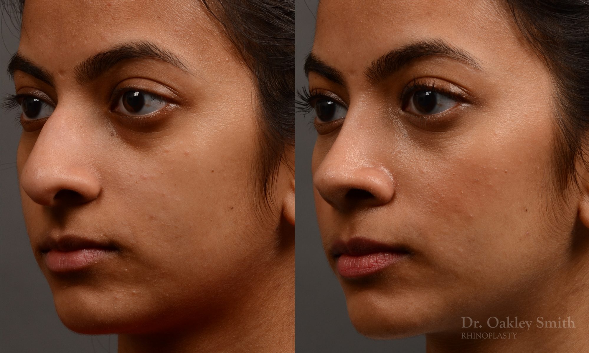 rhinoplasty Nothing demonstrates the skillful craftsmanship that Dr. Oakley Smith accomplishes during his surgeries than a collection of before and after case studies. As one of a hand full of surgeons in North America who limits his practice to only Rhinoplasty surgery, it is obvious that he has mastered his art. There is no question why he is one of the busiest cosmetic nose job surgeons in the country.
