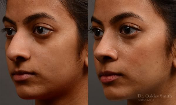 rhinoplasty Nothing demonstrates the skillful craftsmanship that Dr. Oakley Smith accomplishes during his surgeries than a collection of before and after case studies. As one of a hand full of surgeons in North America who limits his practice to only Rhinoplasty surgery, it is obvious that he has mastered his art. There is no question why he is one of the busiest cosmetic nose job surgeons in the country.