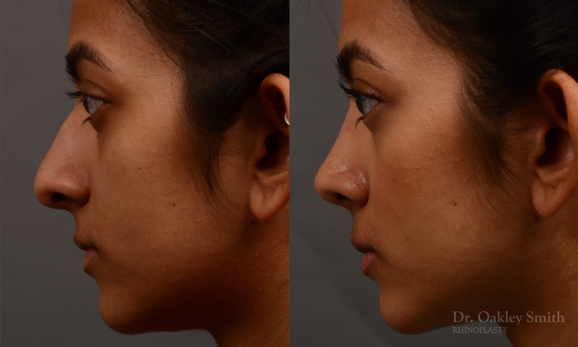 rhinoplasty Nothing demonstrates the skillful craftsmanship that Dr. Oakley Smith accomplishes during his surgeries than a collection of before and after case studies. As one of a hand full of surgeons in North America who limits his practice to only Rhinoplasty surgery, it is obvious that he has mastered his art. There is no question why he is one of the busiest cosmetic nose job surgeons in the country.