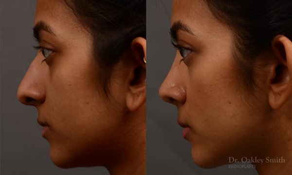 rhinoplasty Nothing demonstrates the skillful craftsmanship that Dr. Oakley Smith accomplishes during his surgeries than a collection of before and after case studies. As one of a hand full of surgeons in North America who limits his practice to only Rhinoplasty surgery, it is obvious that he has mastered his art. There is no question why he is one of the busiest cosmetic nose job surgeons in the country.