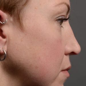 rhinoplasty Nothing demonstrates the skillful craftsmanship that Dr. Oakley Smith accomplishes during his surgeries than a collection of before and after case studies. As one of a hand full of surgeons in North America who limits his practice to only Rhinoplasty surgery, it is obvious that he has mastered his art. There is no question why he is one of the busiest cosmetic nose job surgeons in the country.