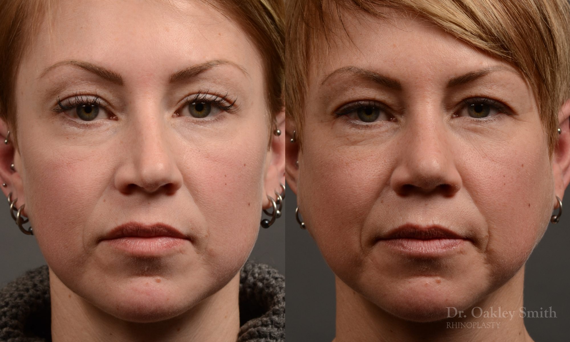 rhinoplasty Nothing demonstrates the skillful craftsmanship that Dr. Oakley Smith accomplishes during his surgeries than a collection of before and after case studies. As one of a hand full of surgeons in North America who limits his practice to only Rhinoplasty surgery, it is obvious that he has mastered his art. There is no question why he is one of the busiest cosmetic nose job surgeons in the country.