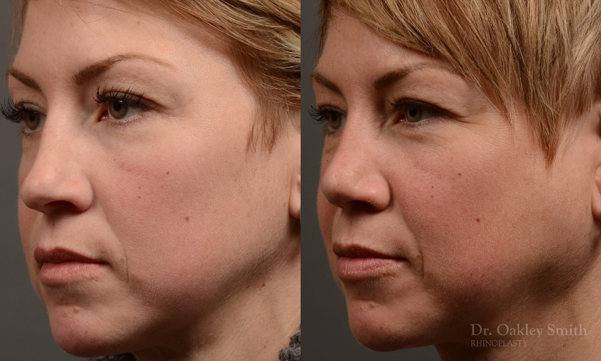 rhinoplasty Nothing demonstrates the skillful craftsmanship that Dr. Oakley Smith accomplishes during his surgeries than a collection of before and after case studies. As one of a hand full of surgeons in North America who limits his practice to only Rhinoplasty surgery, it is obvious that he has mastered his art. There is no question why he is one of the busiest cosmetic nose job surgeons in the country.