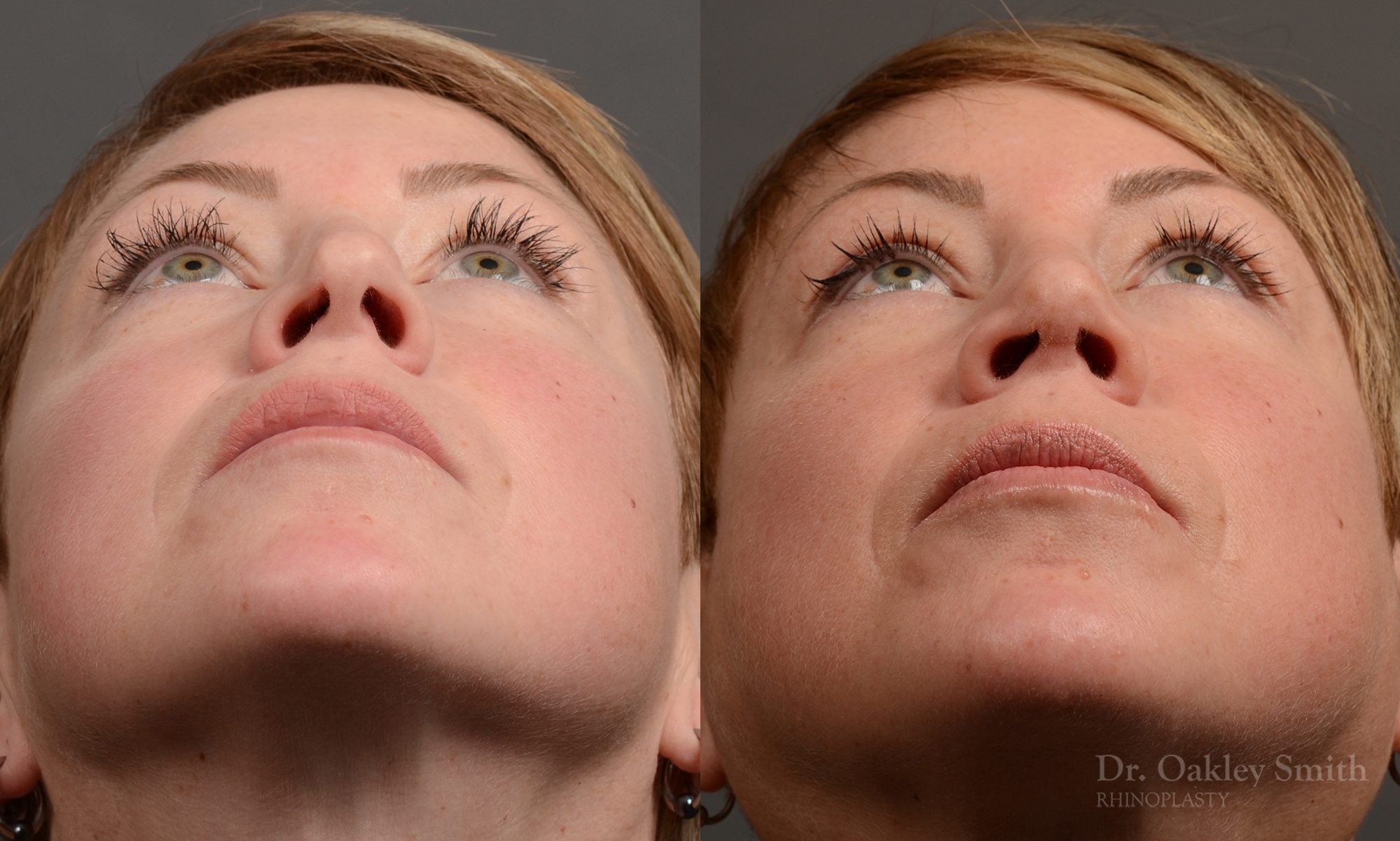 rhinoplasty Nothing demonstrates the skillful craftsmanship that Dr. Oakley Smith accomplishes during his surgeries than a collection of before and after case studies. As one of a hand full of surgeons in North America who limits his practice to only Rhinoplasty surgery, it is obvious that he has mastered his art. There is no question why he is one of the busiest cosmetic nose job surgeons in the country.