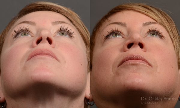 rhinoplasty Nothing demonstrates the skillful craftsmanship that Dr. Oakley Smith accomplishes during his surgeries than a collection of before and after case studies. As one of a hand full of surgeons in North America who limits his practice to only Rhinoplasty surgery, it is obvious that he has mastered his art. There is no question why he is one of the busiest cosmetic nose job surgeons in the country.