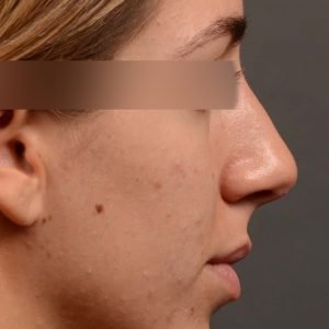 rhinoplasty Nothing demonstrates the skillful craftsmanship that Dr. Oakley Smith accomplishes during his surgeries than a collection of before and after case studies. As one of a hand full of surgeons in North America who limits his practice to only Rhinoplasty surgery, it is obvious that he has mastered his art. There is no question why he is one of the busiest cosmetic nose job surgeons in the country.