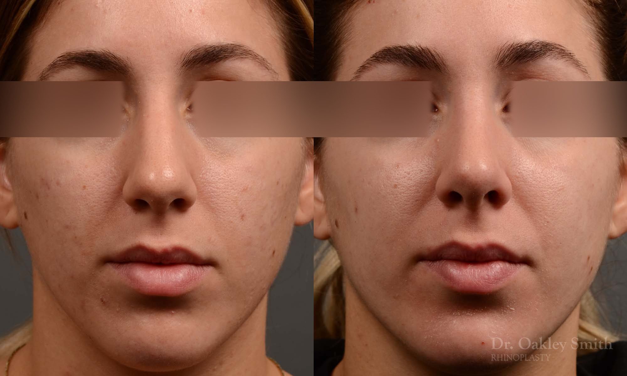 385 - Expert Rhinoplasty nose job surgery to reduce the size of this womans nose.
