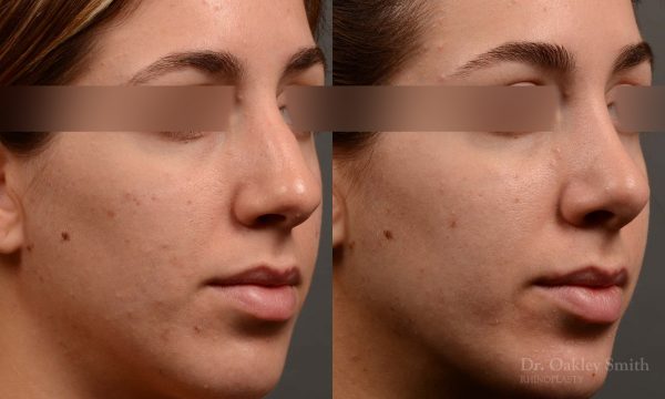 385.1 - Expert Rhinoplasty nose job surgery to reduce the bump on this womans nose.