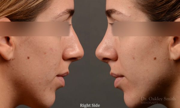 385 - Expert Rhinoplasty nose job surgery to reduce the size of this womans nose.