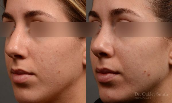 385.1 - Expert Rhinoplasty nose job surgery to reduce the bump on this womans nose.