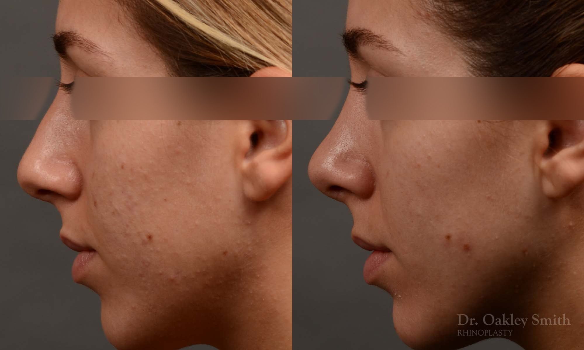 385 - Expert Rhinoplasty nose job surgery to reduce the size of this womans nose.