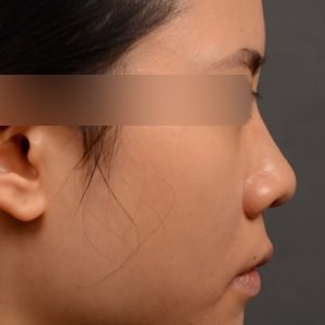 rhinoplasty Nothing demonstrates the skillful craftsmanship that Dr. Oakley Smith accomplishes during his surgeries than a collection of before and after case studies. As one of a hand full of surgeons in North America who limits his practice to only Rhinoplasty surgery, it is obvious that he has mastered his art. There is no question why he is one of the busiest cosmetic nose job surgeons in the country.