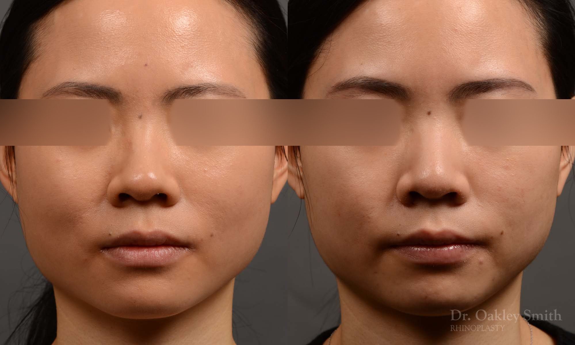 rhinoplasty Nothing demonstrates the skillful craftsmanship that Dr. Oakley Smith accomplishes during his surgeries than a collection of before and after case studies. As one of a hand full of surgeons in North America who limits his practice to only Rhinoplasty surgery, it is obvious that he has mastered his art. There is no question why he is one of the busiest cosmetic nose job surgeons in the country.