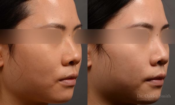 rhinoplasty Nothing demonstrates the skillful craftsmanship that Dr. Oakley Smith accomplishes during his surgeries than a collection of before and after case studies. As one of a hand full of surgeons in North America who limits his practice to only Rhinoplasty surgery, it is obvious that he has mastered his art. There is no question why he is one of the busiest cosmetic nose job surgeons in the country.