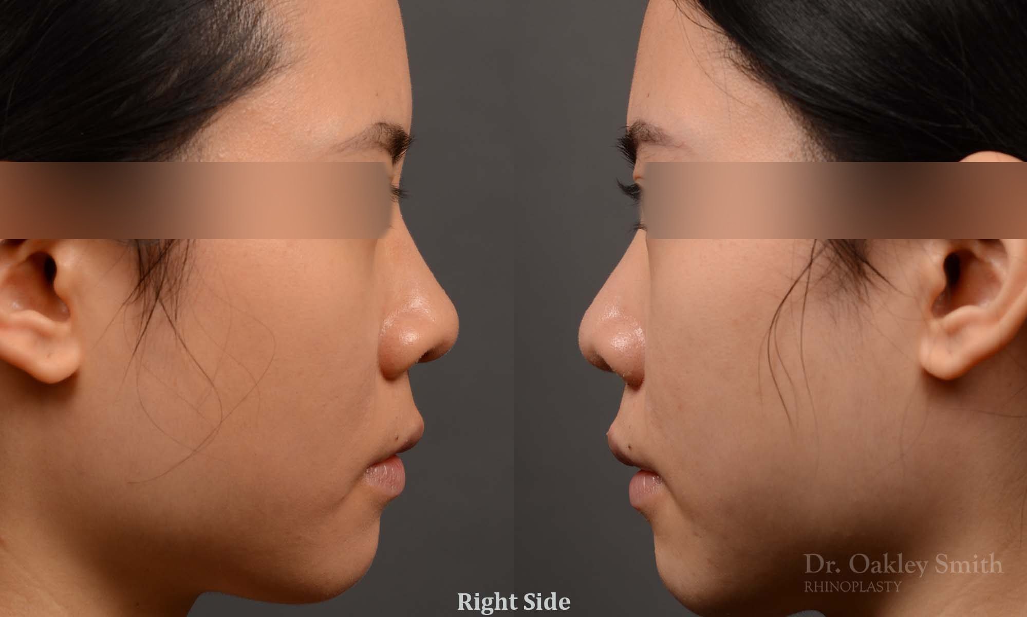 rhinoplasty Nothing demonstrates the skillful craftsmanship that Dr. Oakley Smith accomplishes during his surgeries than a collection of before and after case studies. As one of a hand full of surgeons in North America who limits his practice to only Rhinoplasty surgery, it is obvious that he has mastered his art. There is no question why he is one of the busiest cosmetic nose job surgeons in the country.