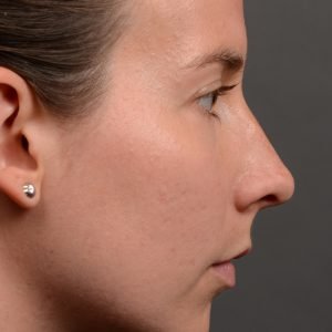 rhinoplasty Nothing demonstrates the skillful craftsmanship that Dr. Oakley Smith accomplishes during his surgeries than a collection of before and after case studies. As one of a hand full of surgeons in North America who limits his practice to only Rhinoplasty surgery, it is obvious that he has mastered his art. There is no question why he is one of the busiest cosmetic nose job surgeons in the country.