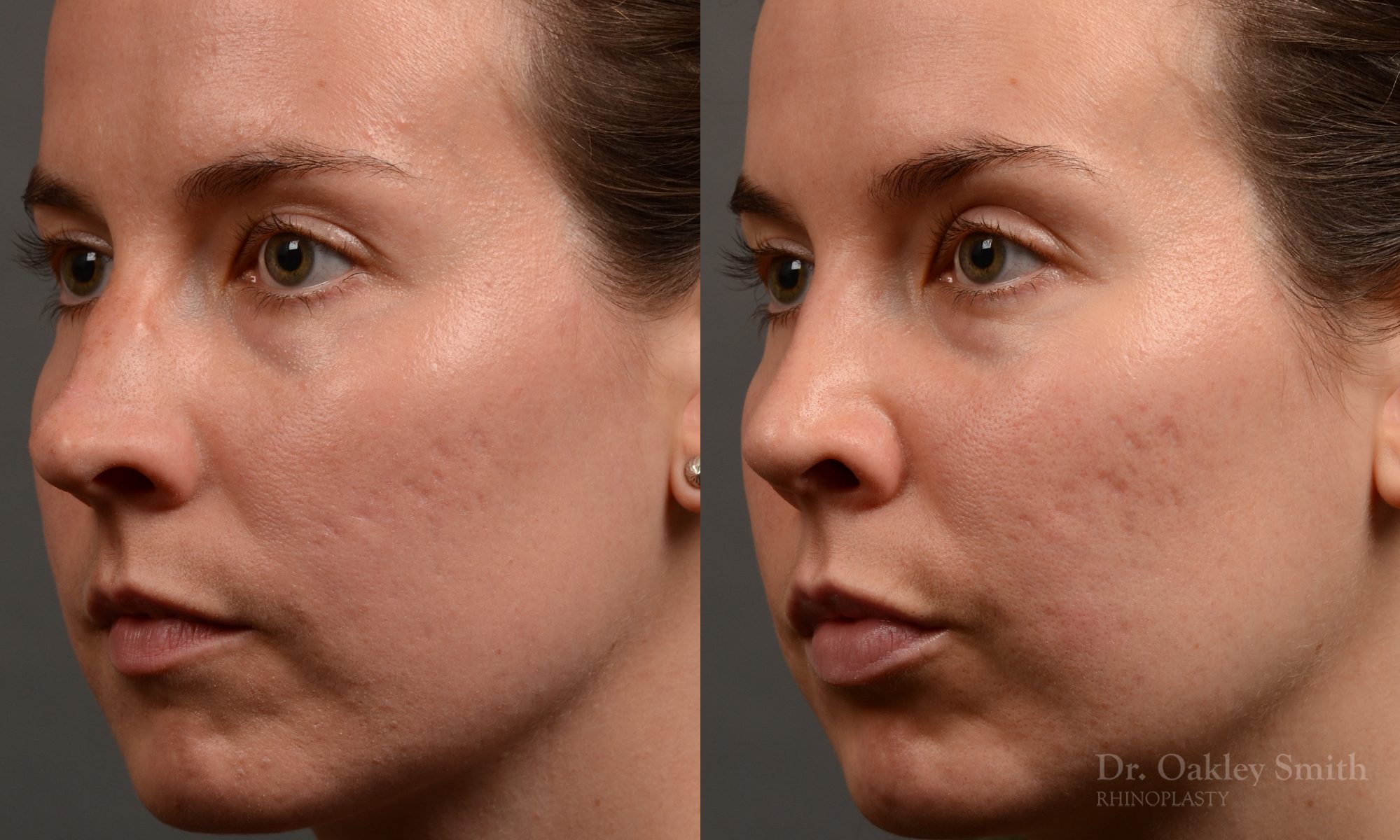 rhinoplasty Nothing demonstrates the skillful craftsmanship that Dr. Oakley Smith accomplishes during his surgeries than a collection of before and after case studies. As one of a hand full of surgeons in North America who limits his practice to only Rhinoplasty surgery, it is obvious that he has mastered his art. There is no question why he is one of the busiest cosmetic nose job surgeons in the country.