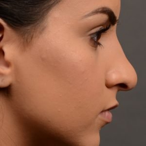 rhinoplasty Nothing demonstrates the skillful craftsmanship that Dr. Oakley Smith accomplishes during his surgeries than a collection of before and after case studies. As one of a hand full of surgeons in North America who limits his practice to only Rhinoplasty surgery, it is obvious that he has mastered his art. There is no question why he is one of the busiest cosmetic nose job surgeons in the country.