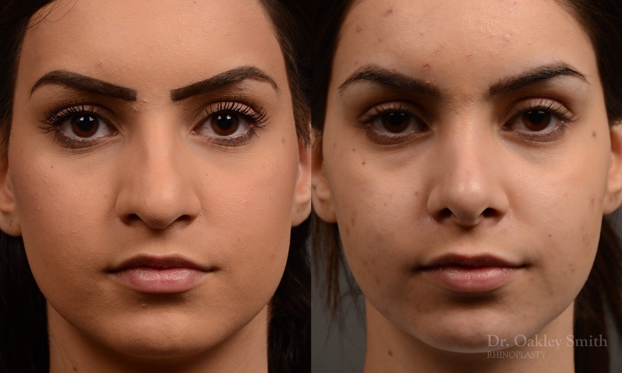 rhinoplasty Nothing demonstrates the skillful craftsmanship that Dr. Oakley Smith accomplishes during his surgeries than a collection of before and after case studies. As one of a hand full of surgeons in North America who limits his practice to only Rhinoplasty surgery, it is obvious that he has mastered his art. There is no question why he is one of the busiest cosmetic nose job surgeons in the country.