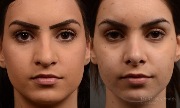 rhinoplasty Nothing demonstrates the skillful craftsmanship that Dr. Oakley Smith accomplishes during his surgeries than a collection of before and after case studies. As one of a hand full of surgeons in North America who limits his practice to only Rhinoplasty surgery, it is obvious that he has mastered his art. There is no question why he is one of the busiest cosmetic nose job surgeons in the country.