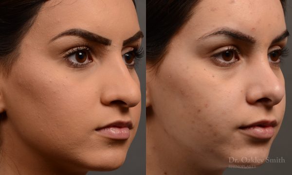 rhinoplasty Nothing demonstrates the skillful craftsmanship that Dr. Oakley Smith accomplishes during his surgeries than a collection of before and after case studies. As one of a hand full of surgeons in North America who limits his practice to only Rhinoplasty surgery, it is obvious that he has mastered his art. There is no question why he is one of the busiest cosmetic nose job surgeons in the country.
