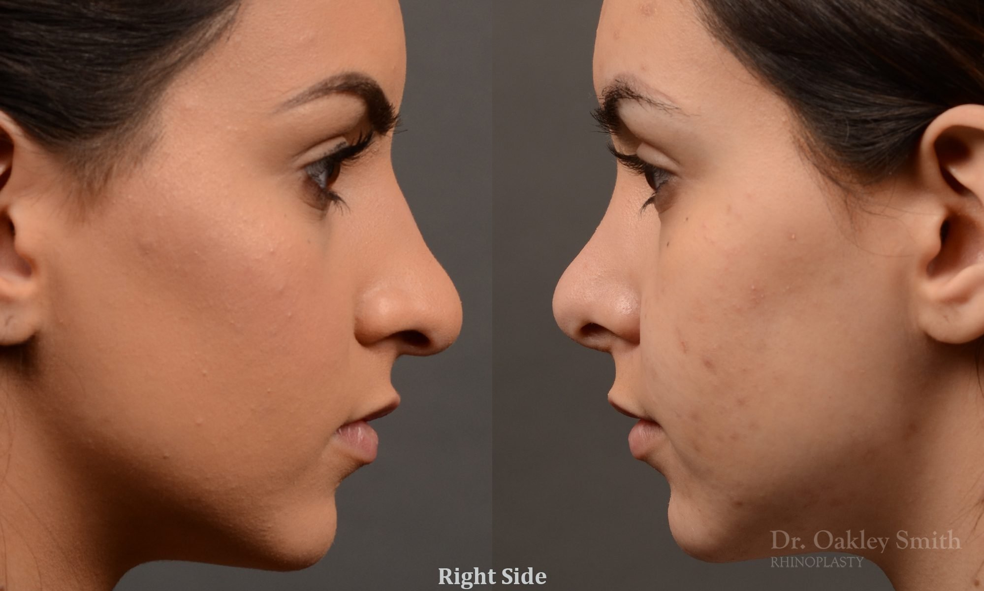 rhinoplasty Nothing demonstrates the skillful craftsmanship that Dr. Oakley Smith accomplishes during his surgeries than a collection of before and after case studies. As one of a hand full of surgeons in North America who limits his practice to only Rhinoplasty surgery, it is obvious that he has mastered his art. There is no question why he is one of the busiest cosmetic nose job surgeons in the country.