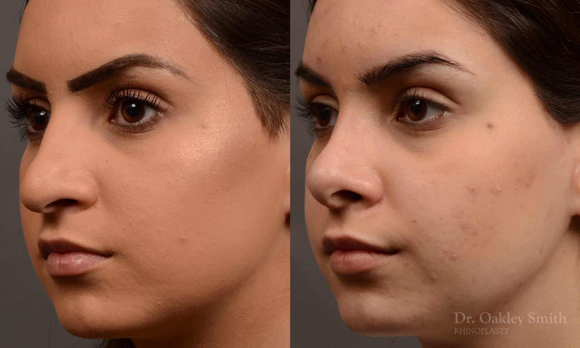 rhinoplasty Nothing demonstrates the skillful craftsmanship that Dr. Oakley Smith accomplishes during his surgeries than a collection of before and after case studies. As one of a hand full of surgeons in North America who limits his practice to only Rhinoplasty surgery, it is obvious that he has mastered his art. There is no question why he is one of the busiest cosmetic nose job surgeons in the country.