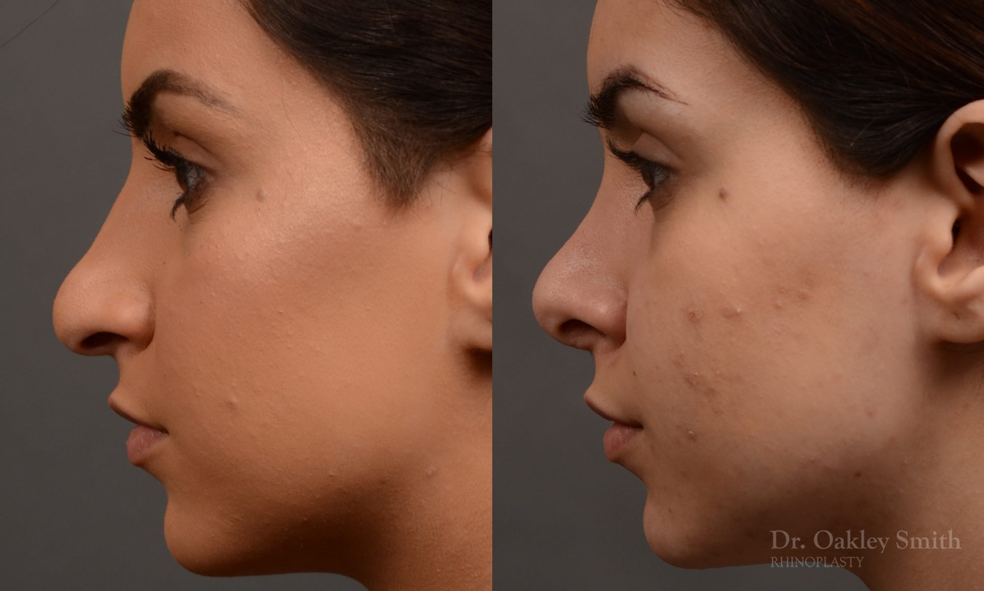 rhinoplasty Nothing demonstrates the skillful craftsmanship that Dr. Oakley Smith accomplishes during his surgeries than a collection of before and after case studies. As one of a hand full of surgeons in North America who limits his practice to only Rhinoplasty surgery, it is obvious that he has mastered his art. There is no question why he is one of the busiest cosmetic nose job surgeons in the country.
