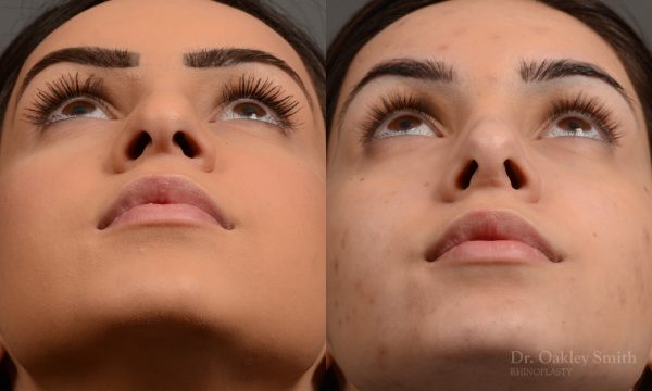 rhinoplasty Nothing demonstrates the skillful craftsmanship that Dr. Oakley Smith accomplishes during his surgeries than a collection of before and after case studies. As one of a hand full of surgeons in North America who limits his practice to only Rhinoplasty surgery, it is obvious that he has mastered his art. There is no question why he is one of the busiest cosmetic nose job surgeons in the country.